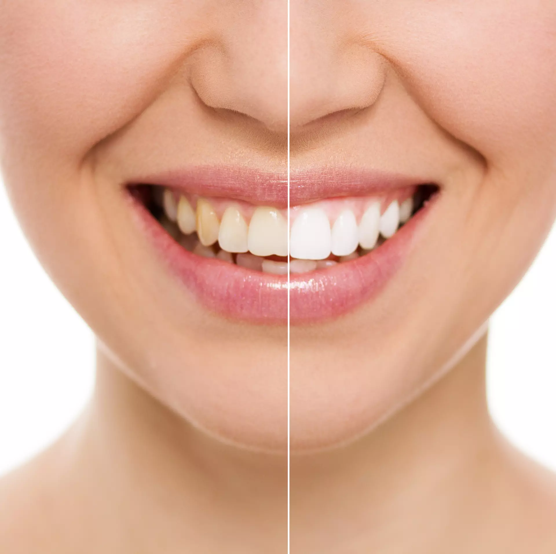 Home Teeth Whitening System